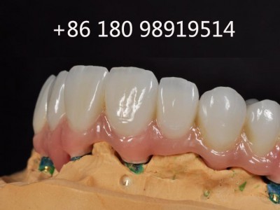 中国义齿实验室 假牙供应商 牙科生产厂家图2