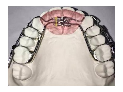 3D打印隐形正畸矫正器 隐形矫公司3D打印图3