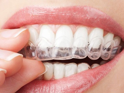深圳义齿加工、牙齿保持器厂家-隐形矫正品牌图2