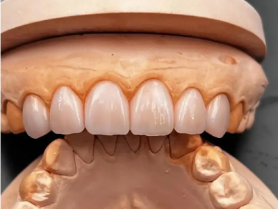 深圳义齿加工、牙齿保持器厂家-隐形矫正品牌图3