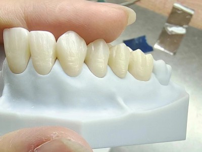 深圳义齿加工厂 深圳假牙加工|烤瓷牙|隐形全口义齿|种植牙齿图1