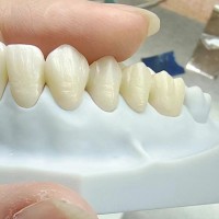 深圳义齿加工厂 深圳假牙加工|烤瓷牙|隐形全口义齿|种植牙齿