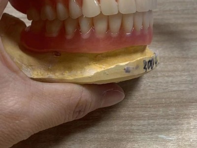 深圳义齿加工厂 深圳假牙加工|烤瓷牙|隐形全口义齿|种植牙齿图2