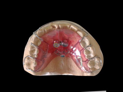 深圳定制式牙齿隐形正畸矫治器-3D隐形矫正-隐形牙套矫治图1